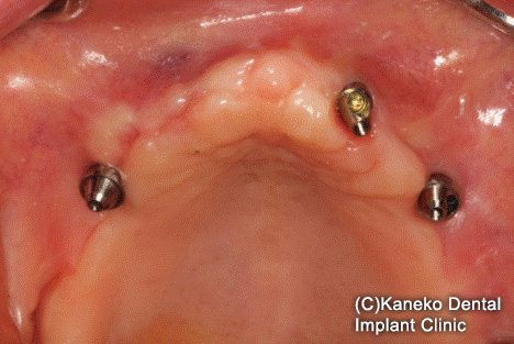 CIST (cumulative interceptive supportive therapy 累積的防御療法) プロトコル