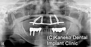 CIST (cumulative interceptive supportive therapy 累積的防御療法) プロトコル