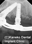 CIST (cumulative interceptive supportive therapy 累積的防御療法) プロトコル