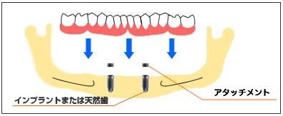 アタッチメント義歯