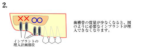 上顎洞挙上術とは