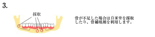 上顎洞挙上術とは