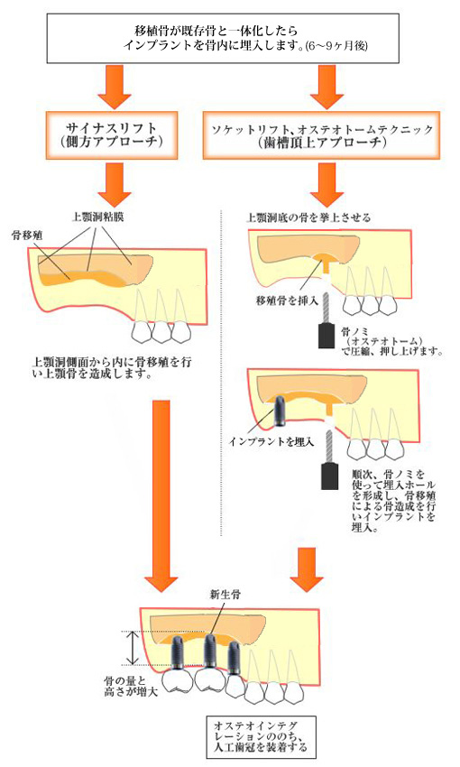 上顎洞挙上術とは