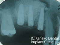 サイナスリフト症例1　(インプラント同時埋入法)