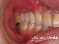サイナスリフト症例1　(インプラント同時埋入法)