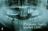 サイナスリフト症例2　(インプラント段階埋入法)