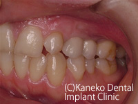 サイナスリフト症例2　(インプラント段階埋入法)
