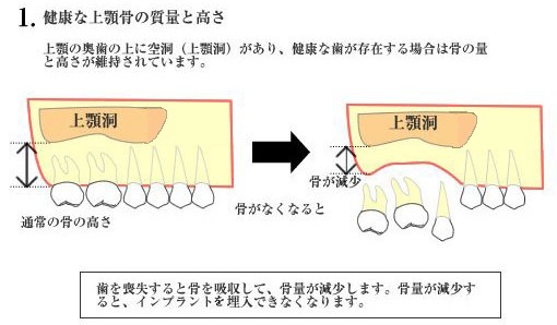 健康な上顎骨の質量と高さ