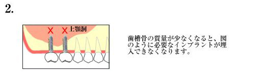 健康な上顎骨の質量と高さ