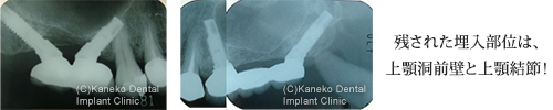 残された埋入部位は、上顎洞前壁と上顎結節！