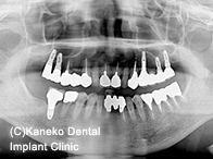 症例1　【2001年：上顎左右大臼歯76 67に4本埋入、術後16年経過】