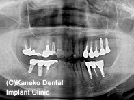 症例3　【2002年：右下大臼歯76埋入、術後15年経過】