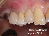 症例5　【2003年：右上臼歯64埋入、術後14年経過】