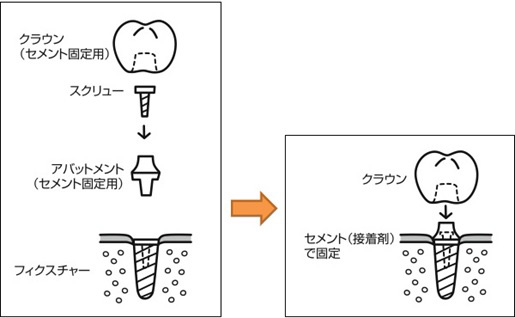 1) インプラント・レベルの上部構造