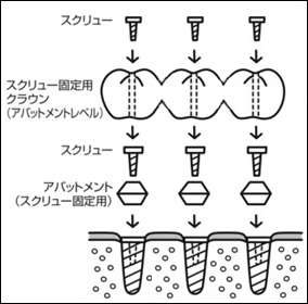 2）アバットメント・レベルの上部構造