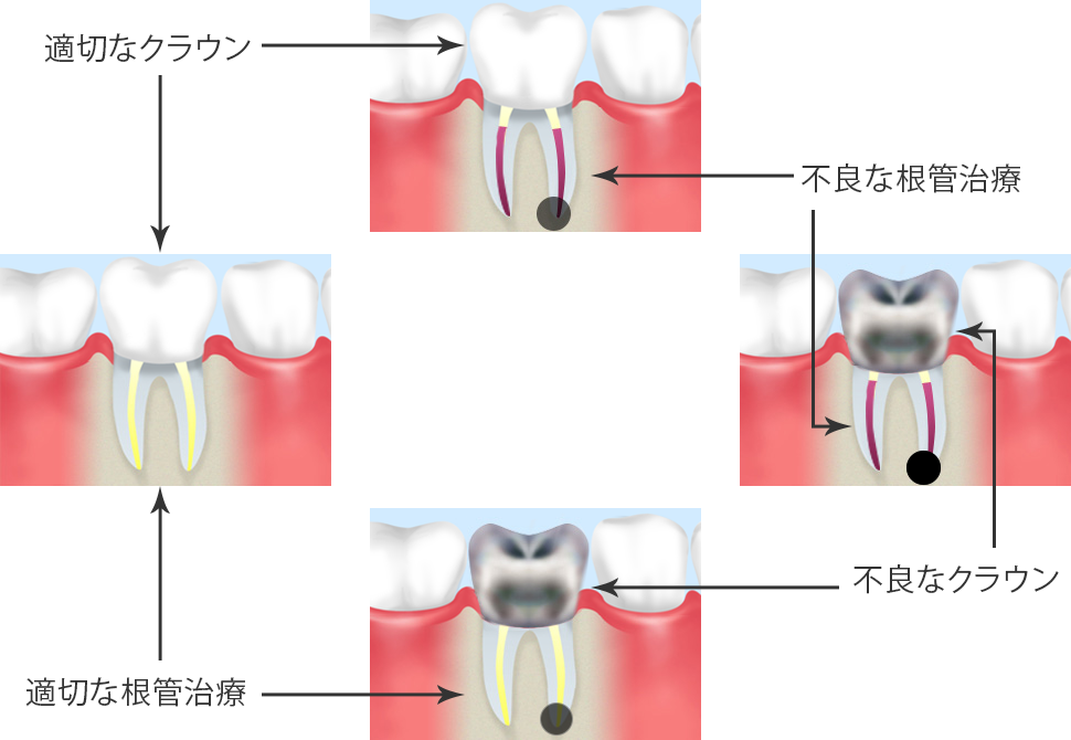 被せ物（クラウン）も根管治療の予後を左右する
