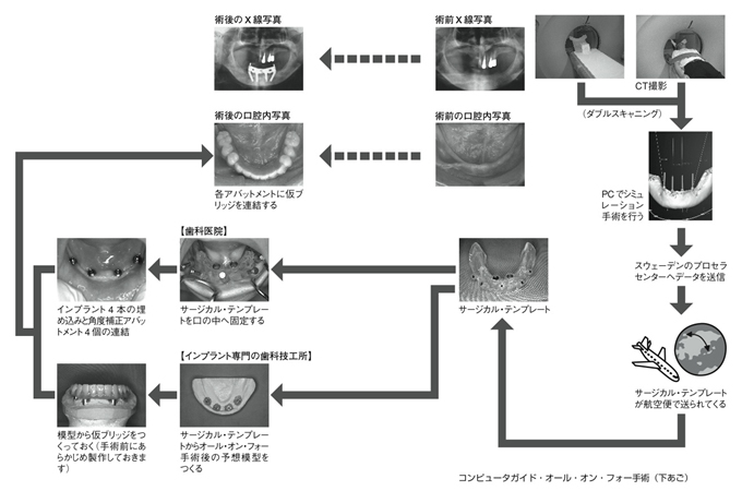 （「オールオンフォー　進化したインプラント治療」医学博士　金子　茂　著より）