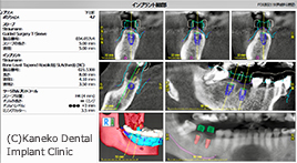 coDiagnosiXソフトウエアでのインプラント埋入計画
