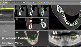 CTデータとSTLデータを重ね合わせ、coDiagnosiXソフトウエアでのインプラント埋入計画を立案