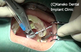 イドを口腔内に締結し、ドリリング