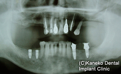 症例1 オール・オン・フォー (インプラント4本) 60歳, 男性