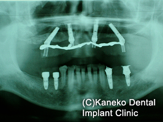 症例1 オール・オン・フォー (インプラント4本) 60歳, 男性