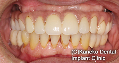 症例１ オール・オン・フォー(インプラント4本) 60歳, 男性