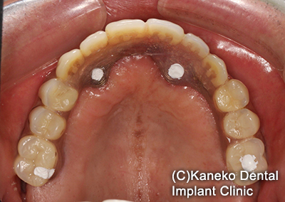 症例１ オール・オン・フォー(インプラント4本) 60歳, 男性