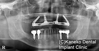 症例１ オール・オン・フォー(インプラント4本) 60歳, 男性