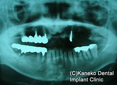 術前(パノラマX線)
