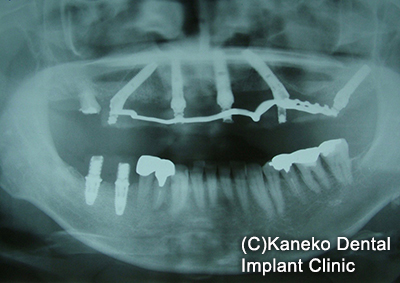 術直後(パノラマX線)