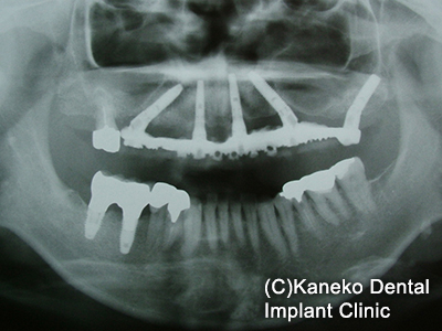症例１ オール・オン・フォー(インプラント4本) 60歳, 男性