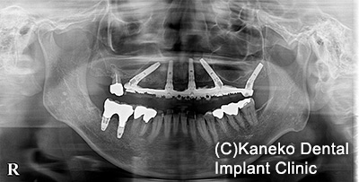 症例2 オール・オン・フォー (インプラント5本), 51歳, 女性「歯が外れて、グラグラしている。」