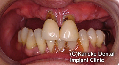 症例3 オール・オン・フォー (インプラント6本)  49歳, 女性
