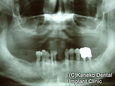 症例3 オール・オン・フォー (インプラント6本)  49歳, 女性
