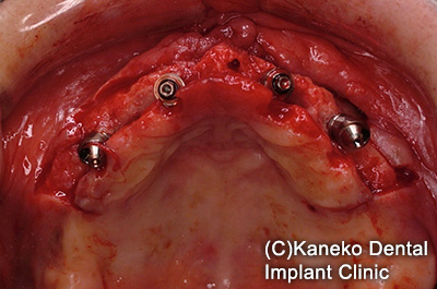 症例3 オール・オン・フォー (インプラント6本), 49歳, 女性