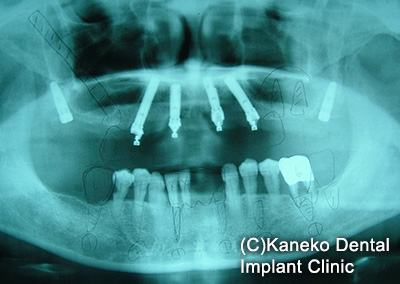 症例3 オール・オン・フォー (インプラント6本), 49歳, 女性