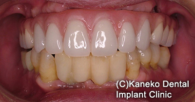 症例3 オール・オン・フォー (インプラント6本), 49歳, 女性