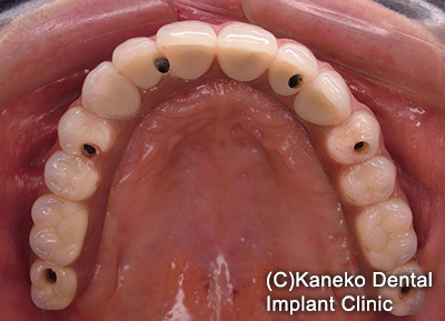 症例3 オール・オン・フォー (インプラント6本), 49歳, 女性