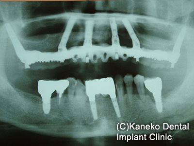 症例3 オール・オン・フォー (インプラント6本), 49歳, 女性