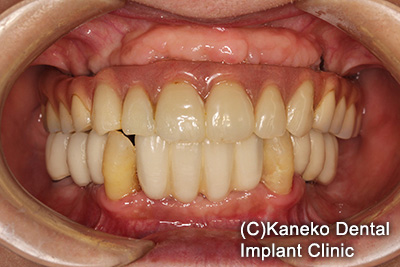 症例3 オール・オン・フォー (インプラント6本), 49歳, 女性