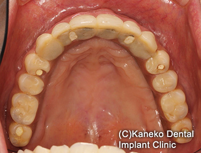 症例3 オール・オン・フォー (インプラント6本), 49歳, 女性