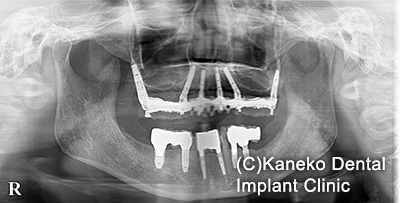 症例3 オール・オン・フォー (インプラント6本), 49歳, 女性