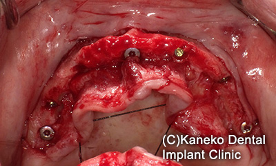 症例4 オール・オン・フォー (インプラント7本)　56歳, 女性