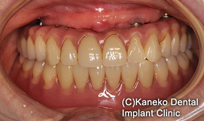 症例4 オール・オン・フォー (インプラント7本)　56歳, 女性