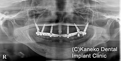 症例4 オール・オン・フォー (インプラント7本)　56歳, 女性