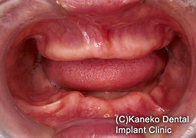 症例5 オール・オン・フォー (インプラント8本) 58歳, 女性