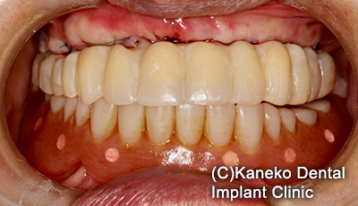 症例5 オール・オン・フォー (インプラント8本) 58歳, 女性