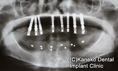 症例5 オール・オン・フォー (インプラント8本) 58歳, 女性