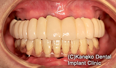症例5 オール・オン・フォー (インプラント8本) 58歳, 女性